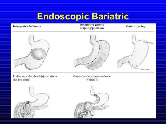 Endoscopy-weight-loss-treatments