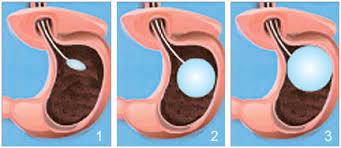 gastric-baloon-treatments