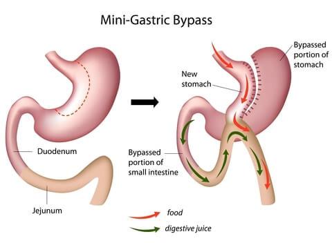 mini-gastric-bypass-mumbai