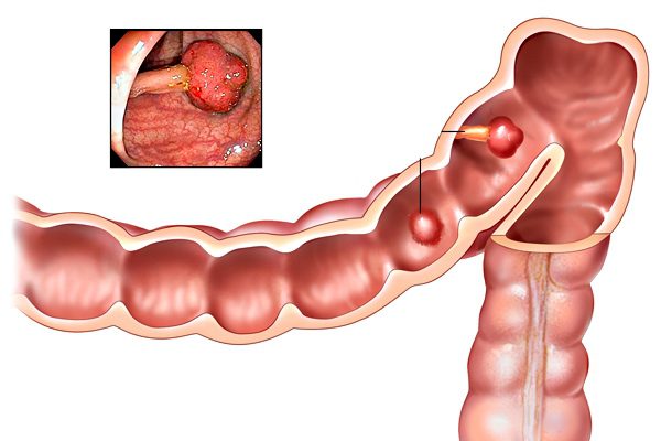 bowel-cancer-treatments