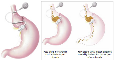 gastric-band-surgery-mumbai