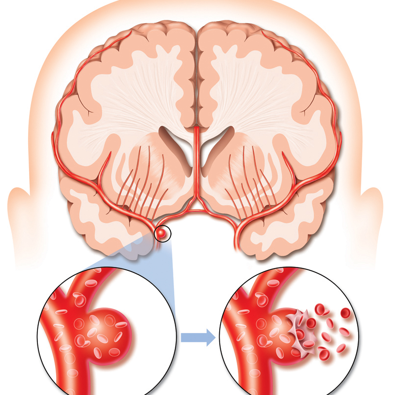 obesity-stroke-treatments-mumbai