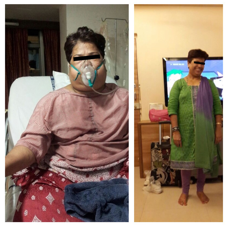 weight loss surgery in mumbai